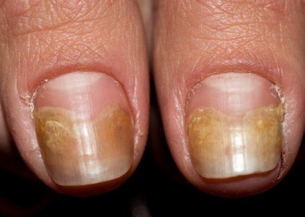 tratamentul ciupercii unghiilor cu iod și sifon