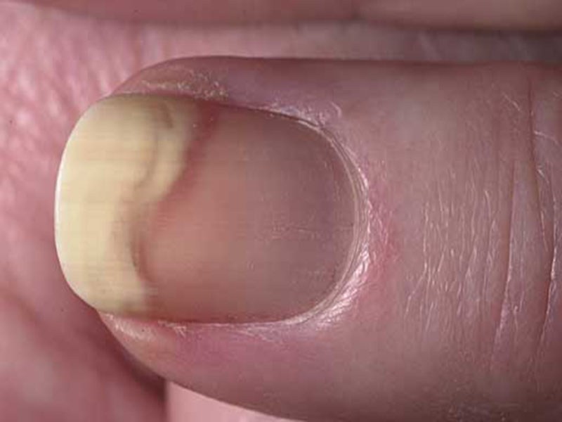 ciuperca distal-laterală a unghiei